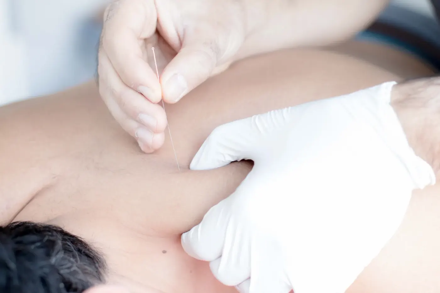 Dry needling