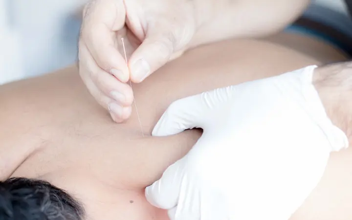 Dry needling